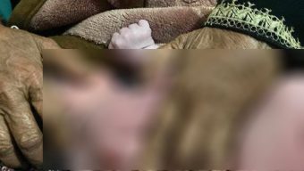 সিজারিয়ান অপারেশনে নবজাতকের পিঠ কেটে ফেললেন চিকিৎসক!