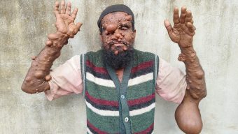 চিকিৎসার টাকা নেই, হতদরিদ্র ছালামের হাজার হাজার টিউমারের  সাথে