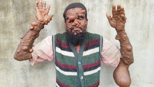 চিকিৎসার টাকা নেই, হতদরিদ্র ছালামের হাজার হাজার টিউমারের  সাথে