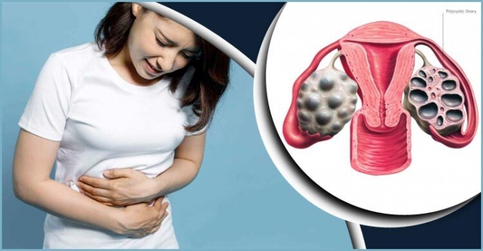 পিসিওএস থেকে মুক্তি পেতে নারীরা যা করবেন