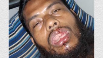যুবকের ৫টি দাঁত ভাঙল প্রতিপক্ষ