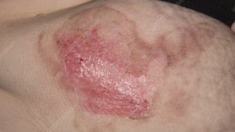 বরিশালে গরম পানিতে গৃহকর্মীর শরীর ঝলসে দিল নারী