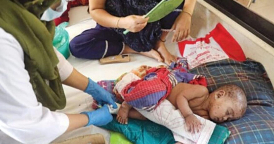 বরিশালে হাম আক্রান্ত হয়ে আরো দুই শিশুর মৃত্যু